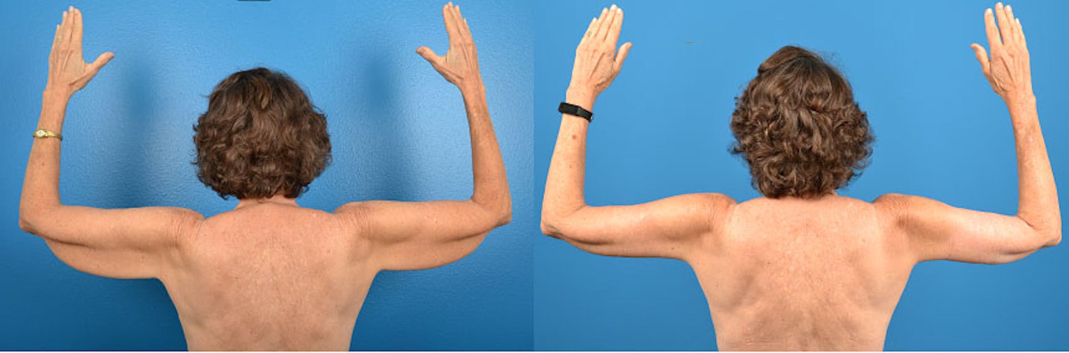 Arm Lift