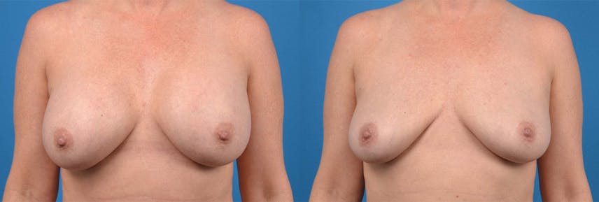 Breast Implant Removal