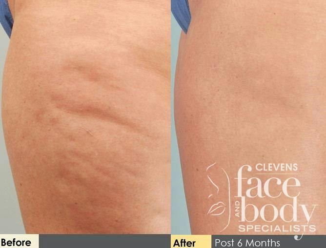 Cellulite Reduction Procedure
