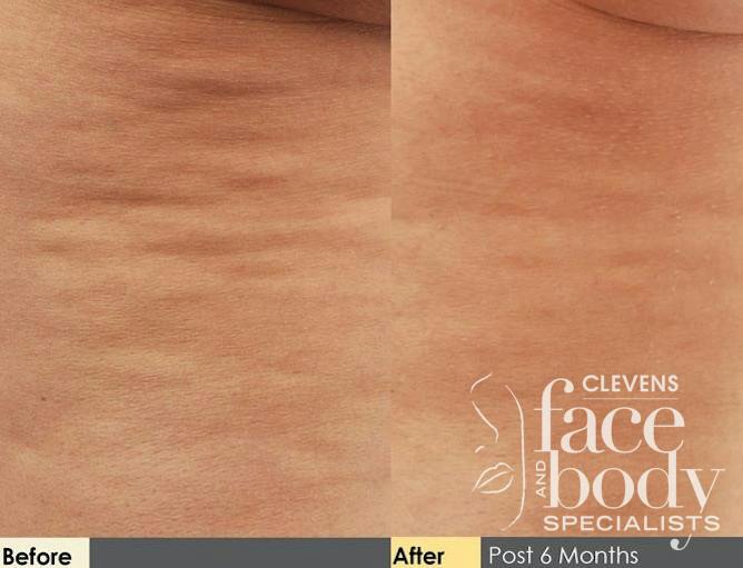 Cellulite Reduction Procedure