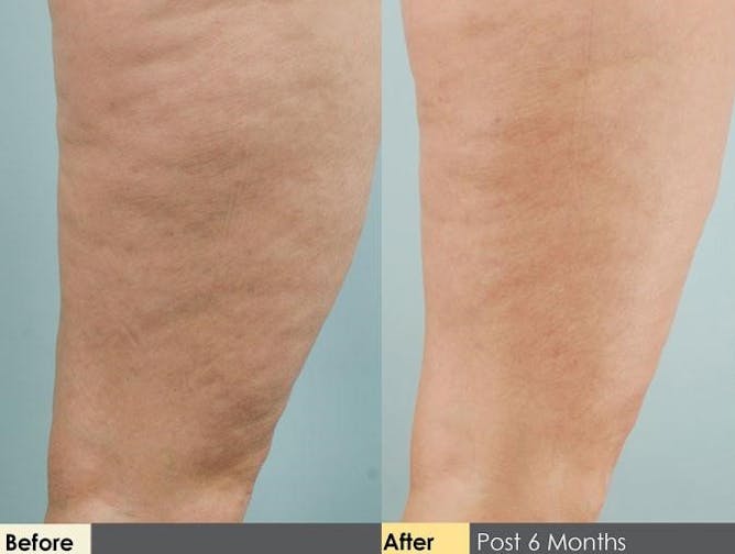 Cellulite Reduction Procedure