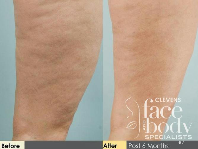 Cellulite Reduction Procedure