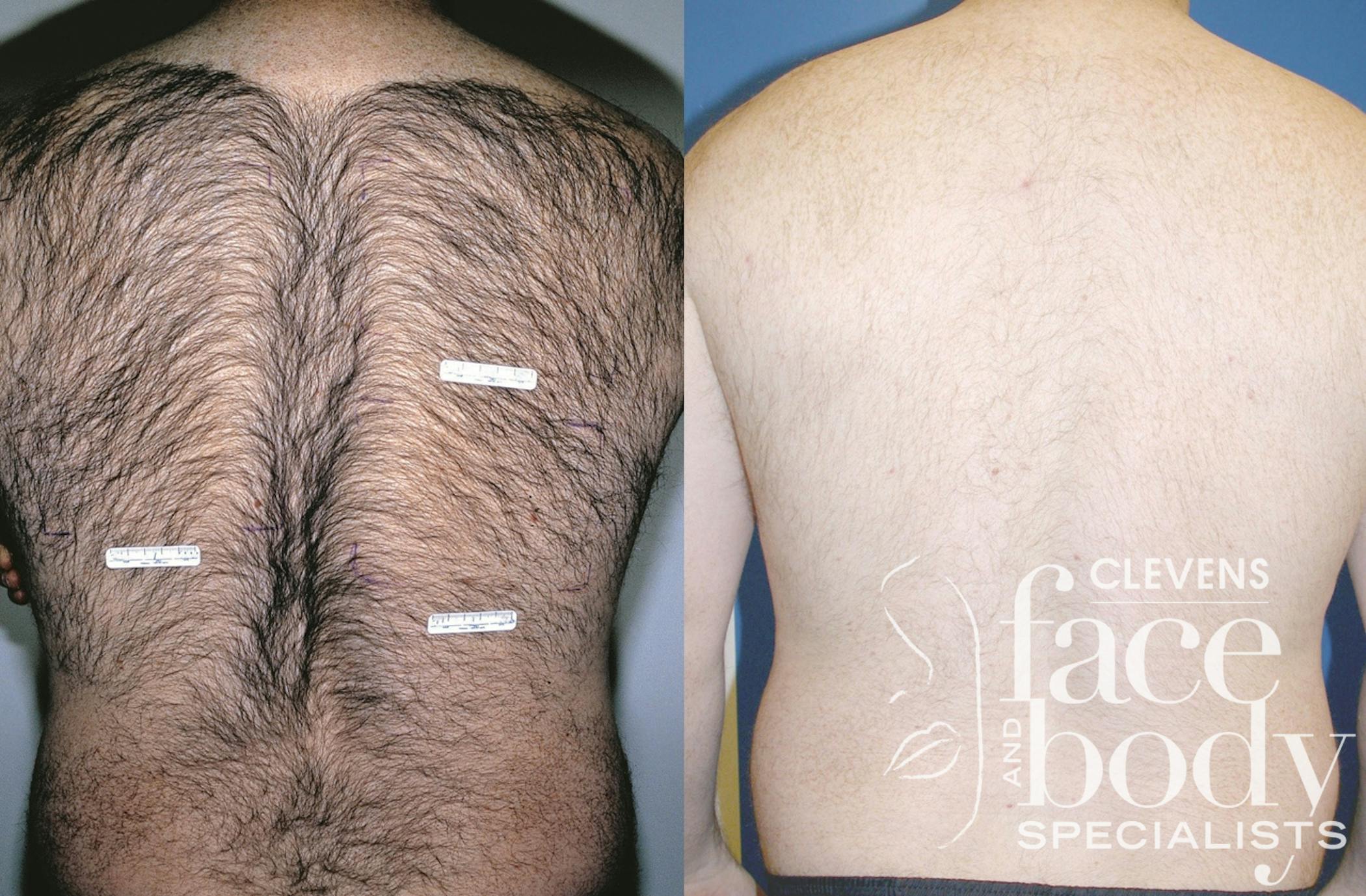 Laser Hair Removal