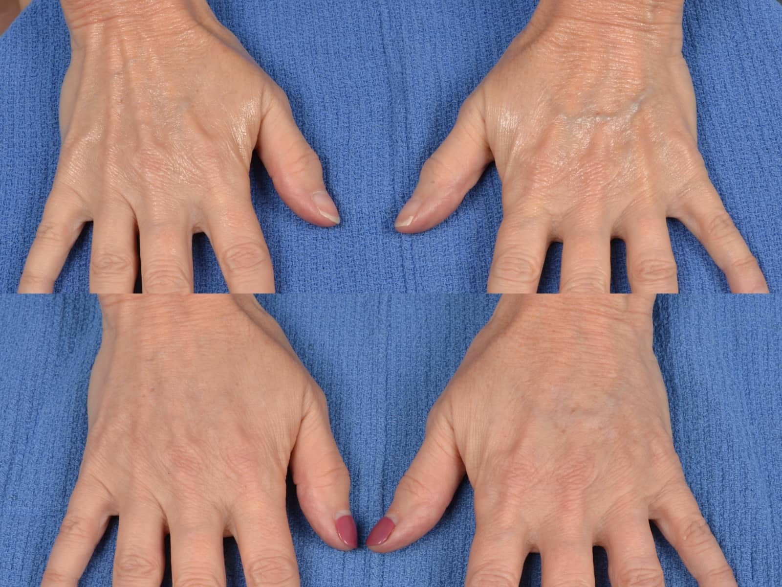 Hand Lift