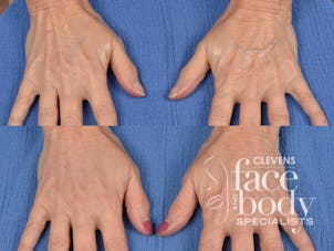 Hand Lift