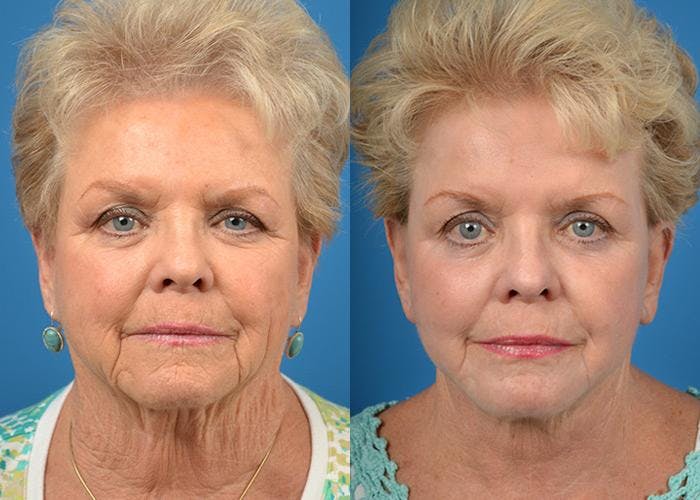 Laser Treatments