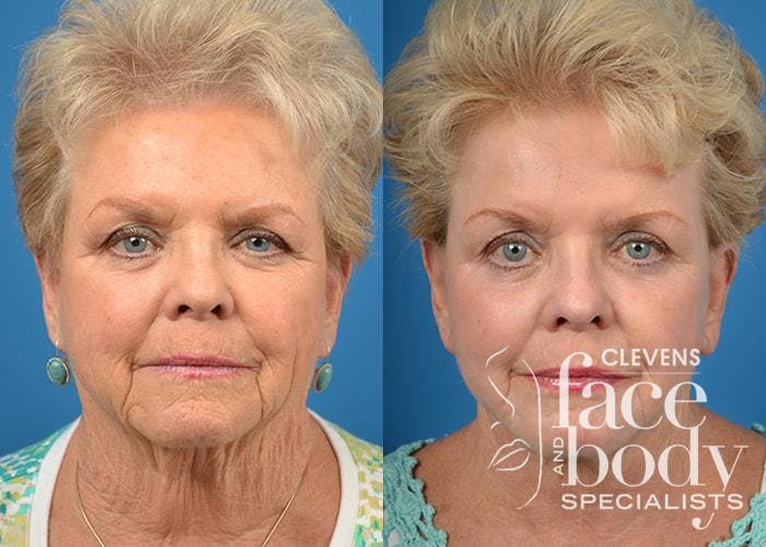Laser Treatments