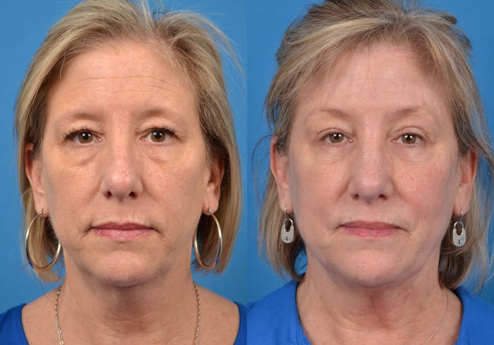 Laser Treatments