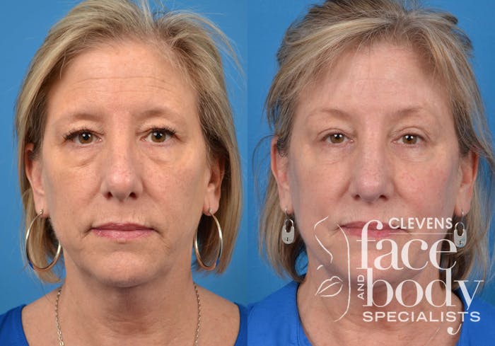 Laser Treatments