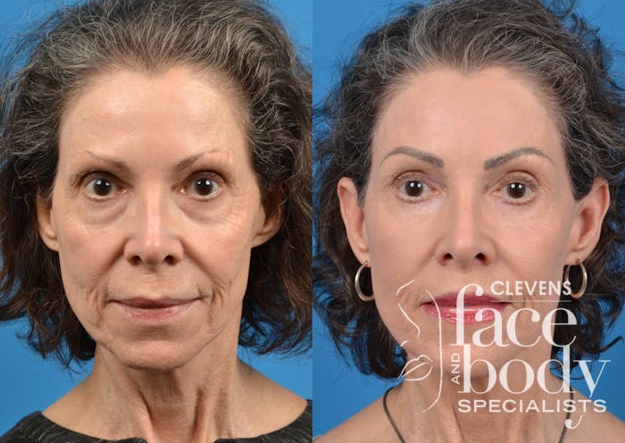 Laser Treatments