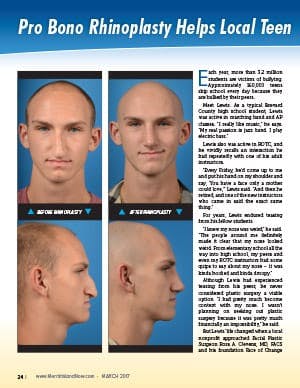 PRO BONO Rhinoplasty