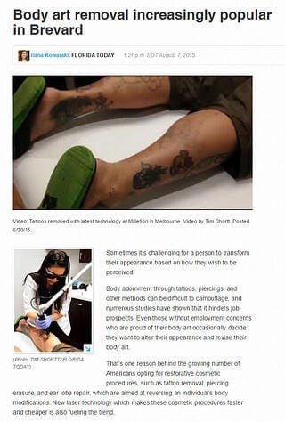 Body art removal increasingly popular in Brevard
