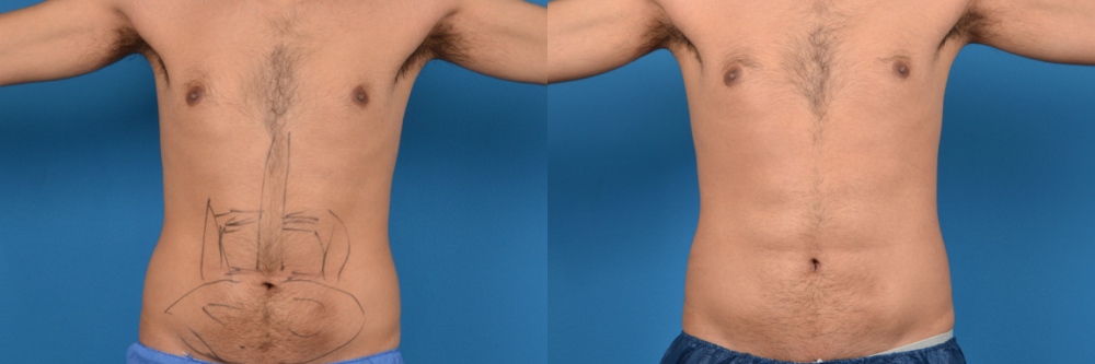 Hidden Liposuction  Before & After Gallery - Patient 211642 - Image 1