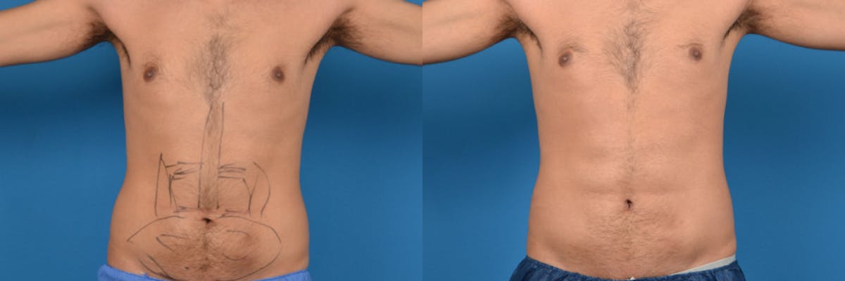 Hidden Liposuction  Before & After Gallery - Patient 211642 - Image 1