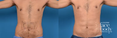 Hidden Liposuction  Before & After Gallery - Patient 211642 - Image 1