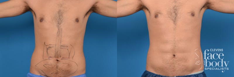 Hidden Liposuction Before & After Gallery - Patient 211642 - Image 1