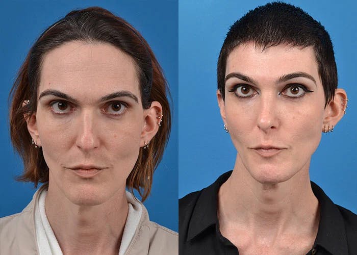 Patient 122595432 Facial Feminization Before And After Photos Clevens