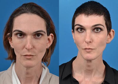 Facial Feminization Before & After Gallery - Patient 122595432 - Image 1