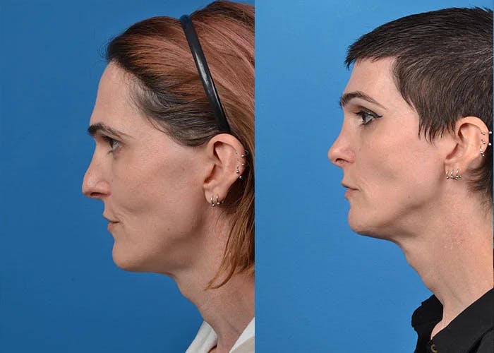 Facial Feminization Before & After Gallery - Patient 122595432 - Image 2