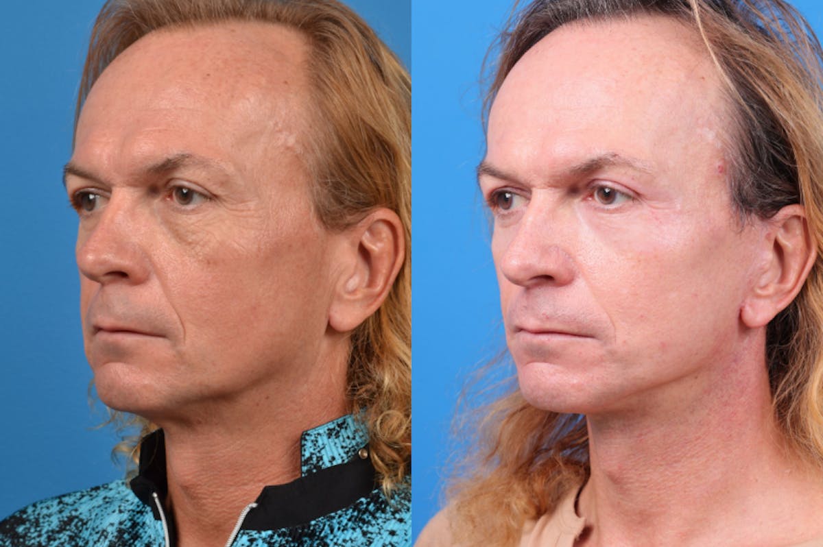 Facelift Before & After Gallery - Patient 122406145 - Image 5