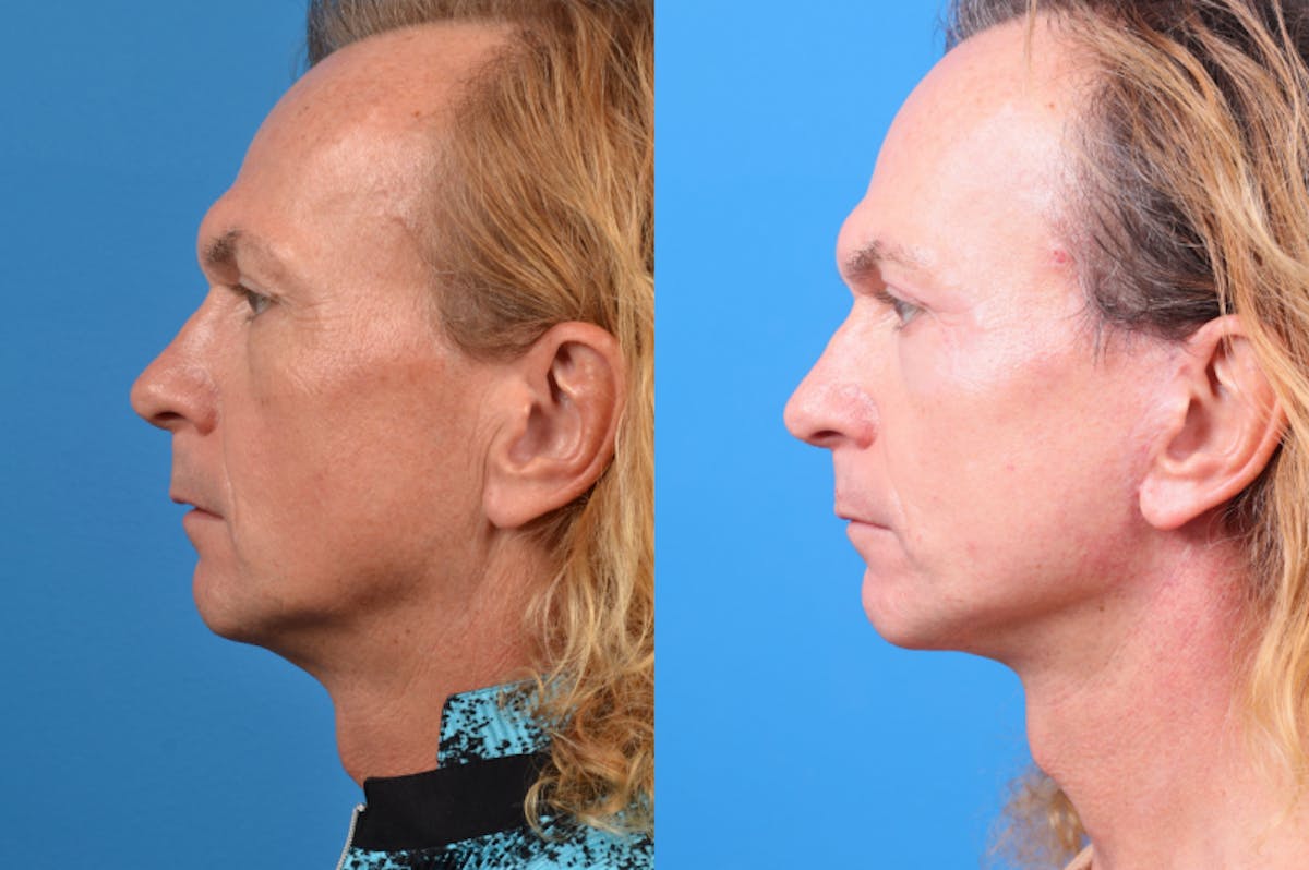 Facelift Before & After Gallery - Patient 122406145 - Image 4
