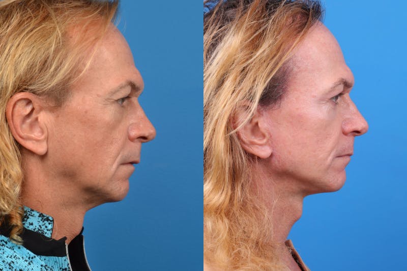 Facelift Before & After Gallery - Patient 122406145 - Image 3