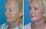 Natural Face Lift Results