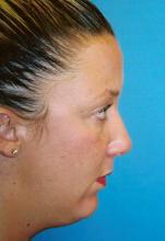 Facial Implant Surgery Side View Before Photo in Melbourne Florida