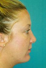 Facial Implant Surgery Side View After Photo in Melbourne Florida