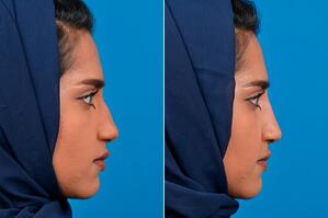 Liquid Rhinoplasty