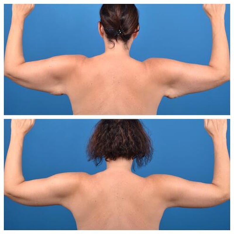 Arm Lift Before & After