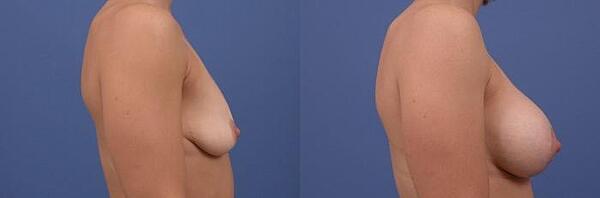 breast augmentation