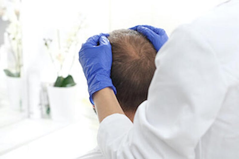 Man Receiving Hair Restoration Treatment