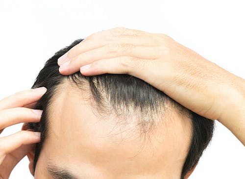 Hairline Lowering Surgery: The Hair Restoration Procedure Nobody is Talking About Hairline Lowering Surgery: The Hair Restoration Procedure Nobody is Talking About