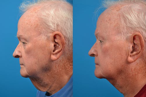 Neck Lift Before & After