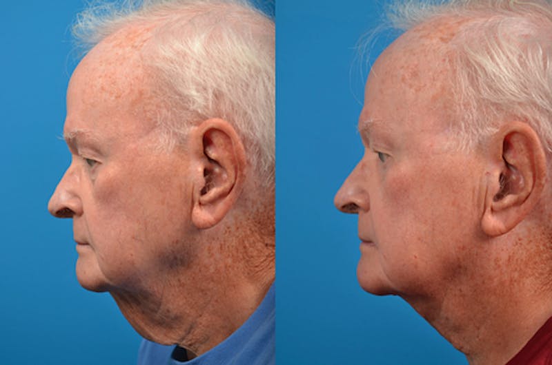 Neck Lift Before & After
