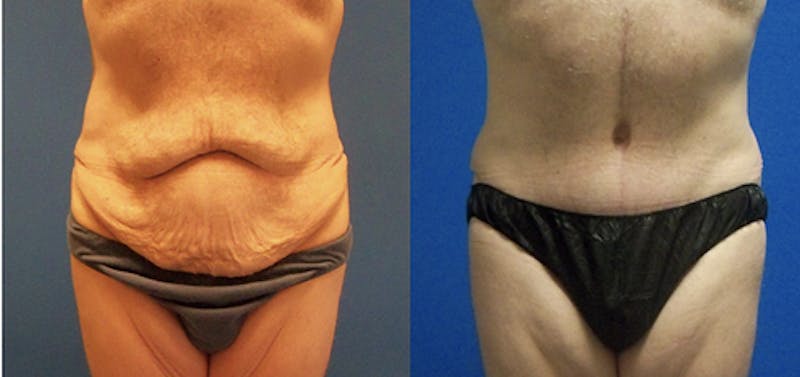 Before & After