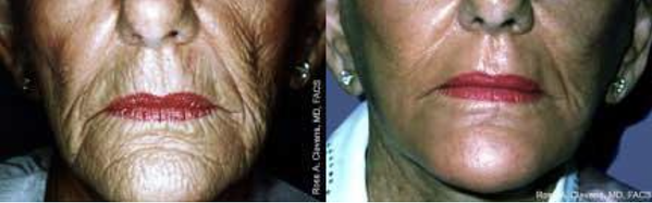 Laser Skin Resurfacing Around Mouth_Before and After_Clevens