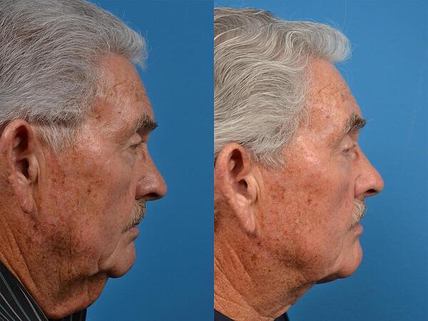patient-56740-male-necklift-before-after-2