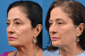 Liquid Facelift