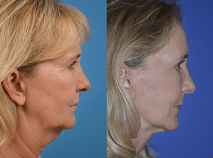 Laser Skin Resurfacing