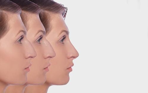 Image of woman duplicated 3 times on top of eachother to show cahnges in nose shape