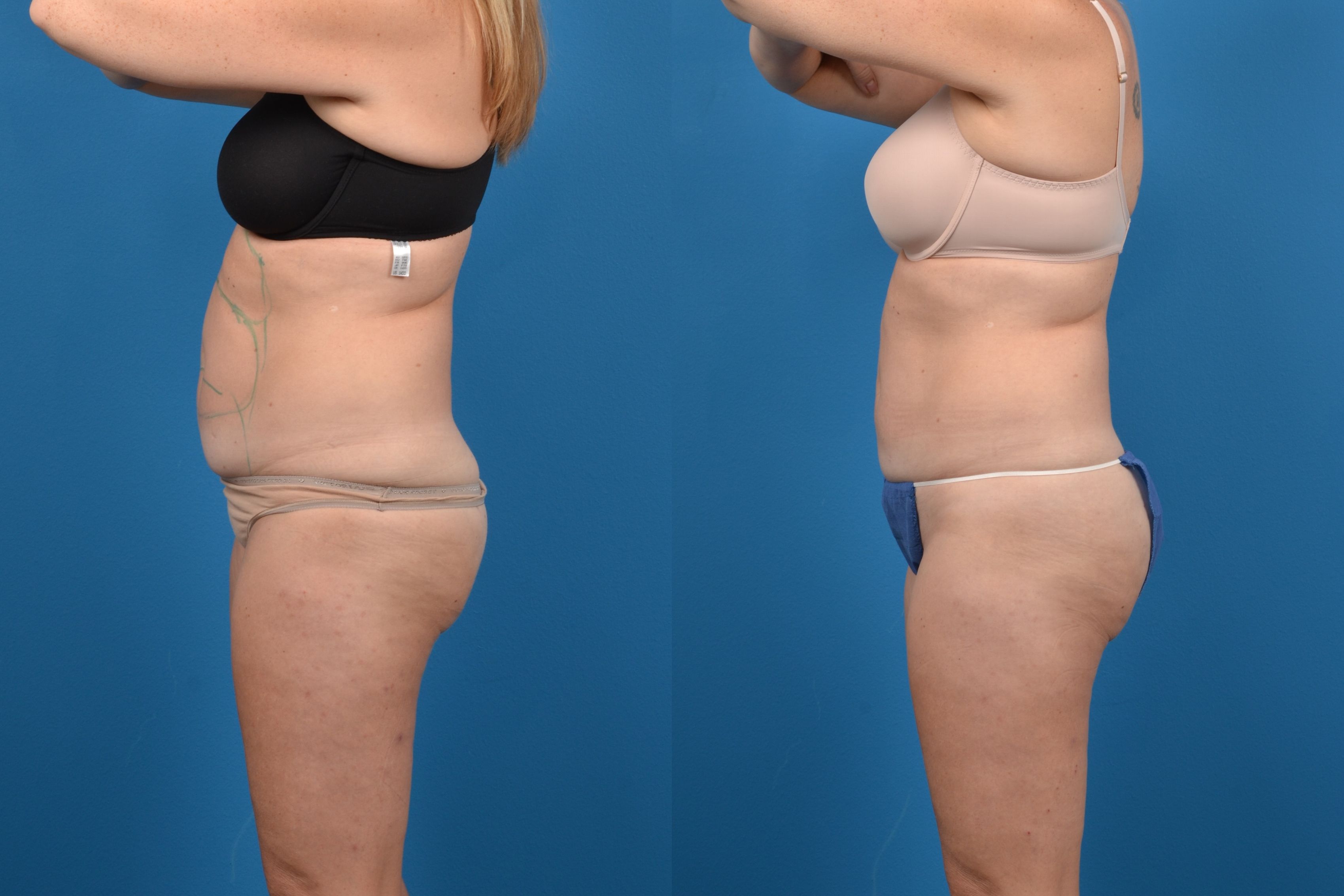 CoolSculpting Before & After Gallery - Patient 405516 - Image 1