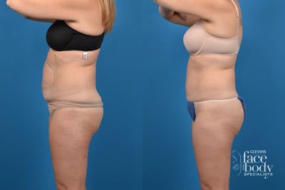 CoolSculpting Before & After Gallery - Patient 405516 - Image 1
