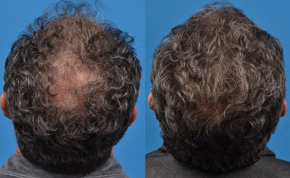 Hair Restoration Before & After Gallery - Patient 122405270 - Image 1