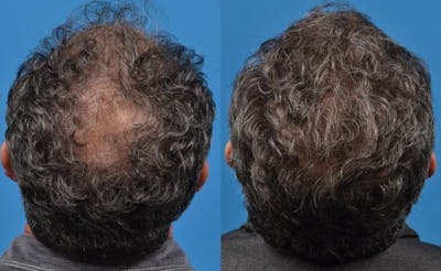 Hair Restoration Before & After Gallery - Patient 122405270 - Image 1