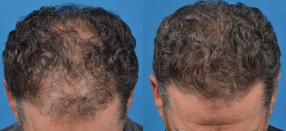 Hair Restoration Before & After Gallery - Patient 122405270 - Image 2
