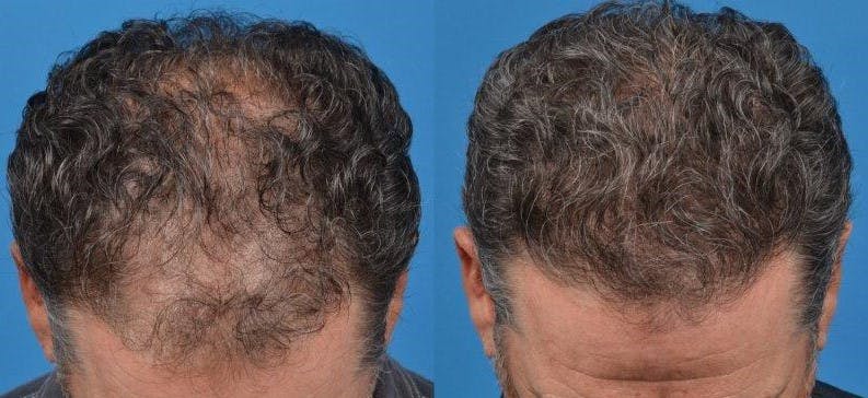 Hair Restoration Gallery - Patient 122405270 - Image 2