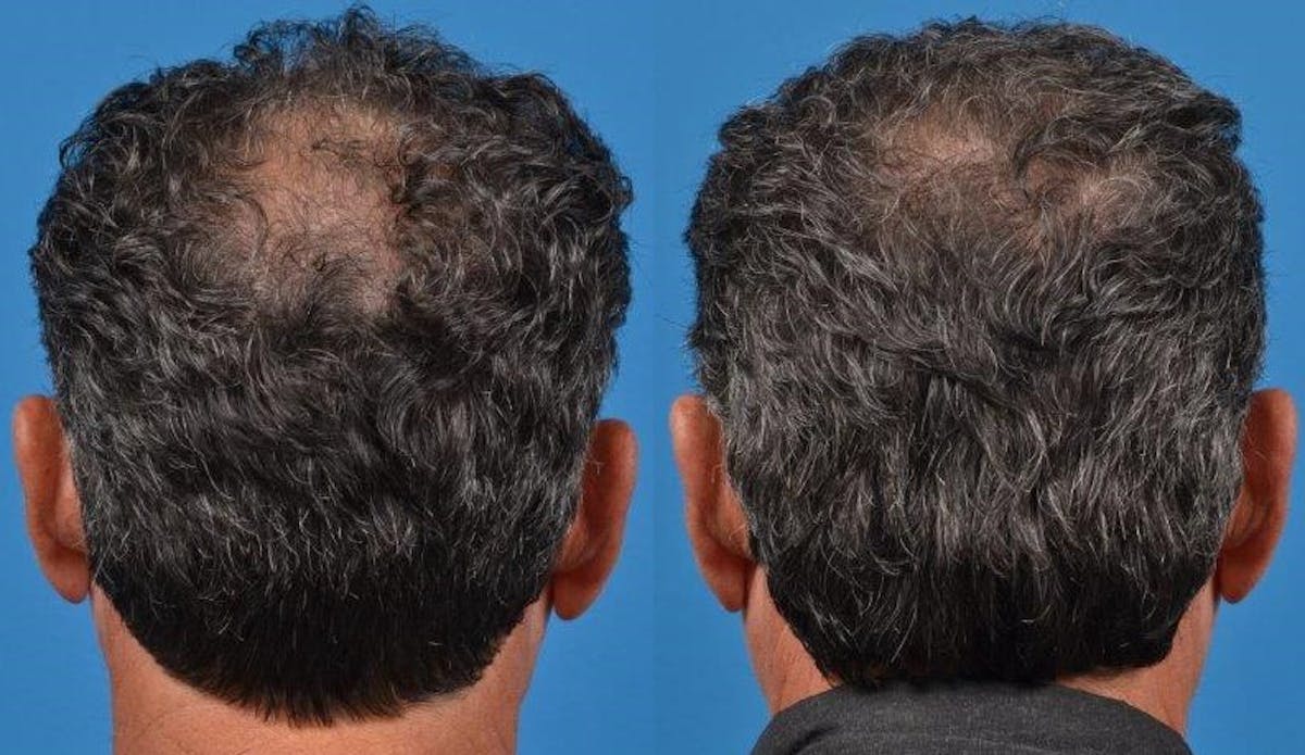 Hair Restoration Before & After Gallery - Patient 122405270 - Image 3