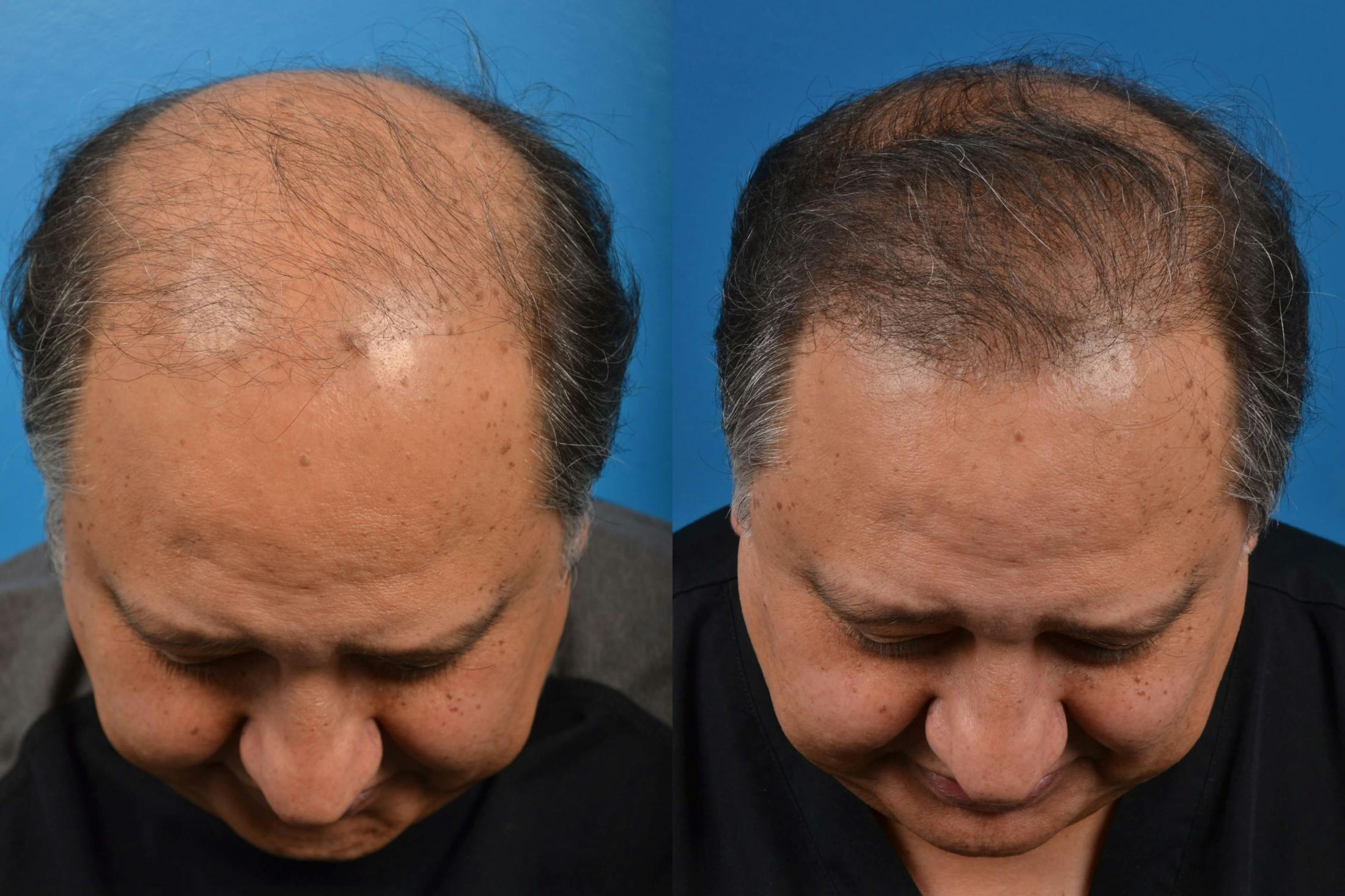 Hair Restoration Before & After Gallery - Patient 122405272 - Image 1